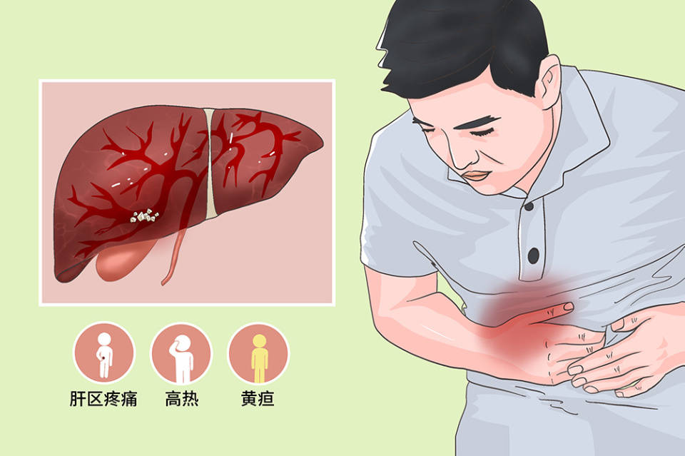 廣州和諧醫院健康科普:膽道結石是由什麼原因引起的?