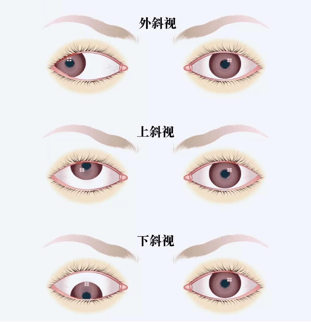 首先我们要知道,斗鸡眼虽然是斜视,但是也仅仅是斜视的一种类型,所以