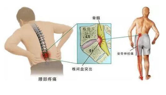 專家推薦5款輕鬆運動幫你擺脫疼痛_壓力_脊柱_朋友