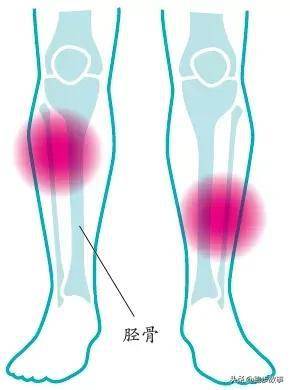 足底跟腱小腿膝蓋四種常見跑步疼痛的解決方案請查收