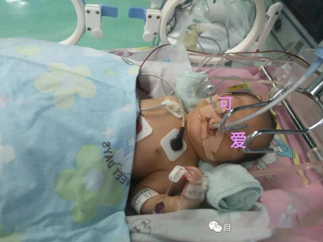 由自贡四医院多科联合救治的宝贝康复出院啦!