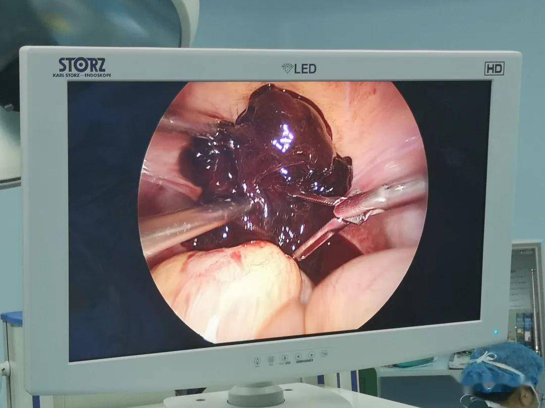 周日上午一台急诊:黄体破裂.患者对异体血的依赖锐减.