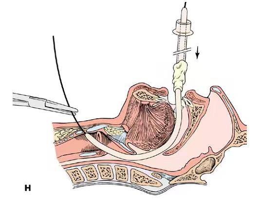 实用技术 | 逆行引导气管插管