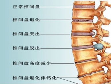 北亚科普小课堂第8课腰椎间盘突出症