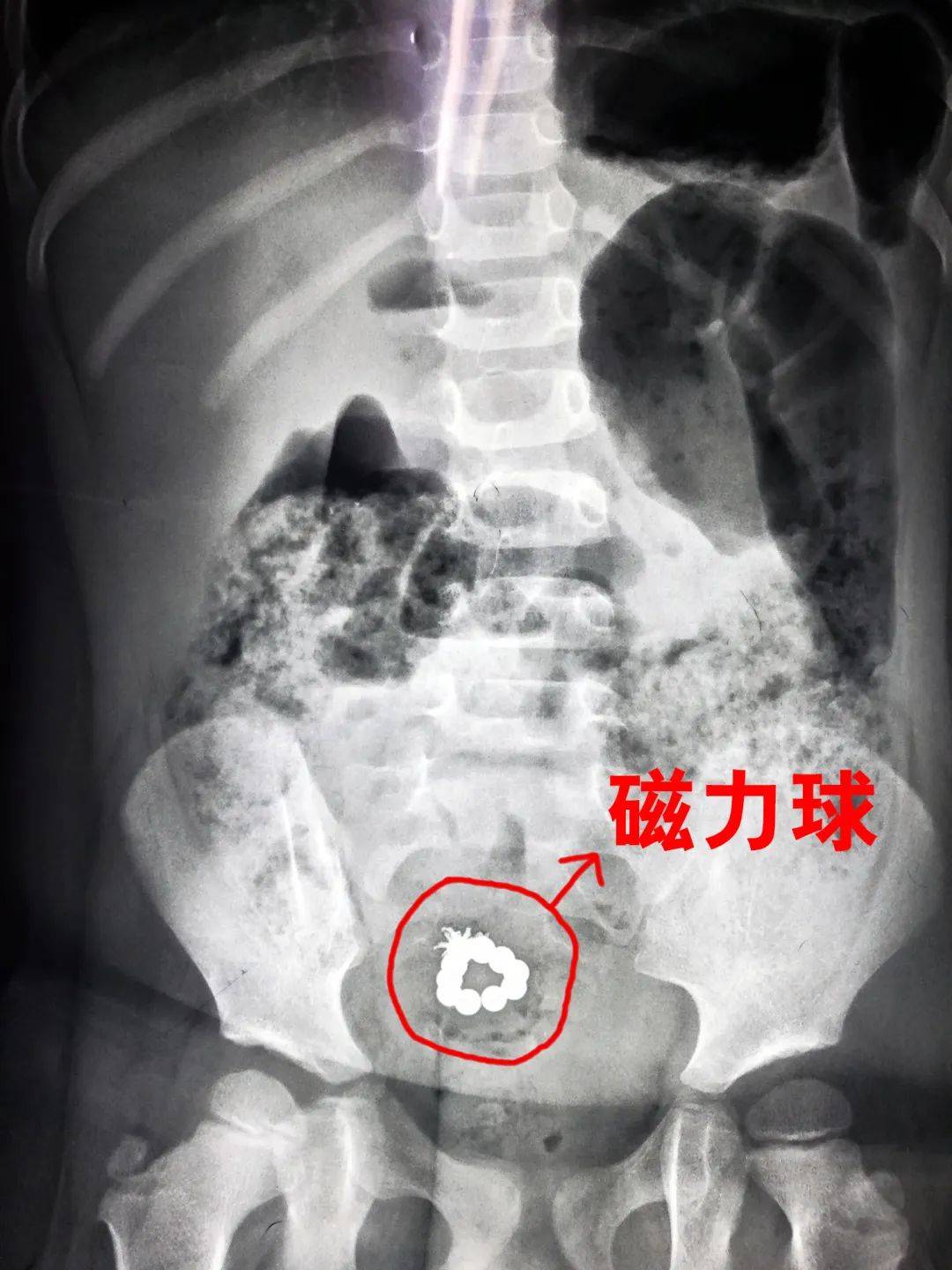 误食一颗磁力球多久能排出来=误食一颗磁力球多久能排出来啊