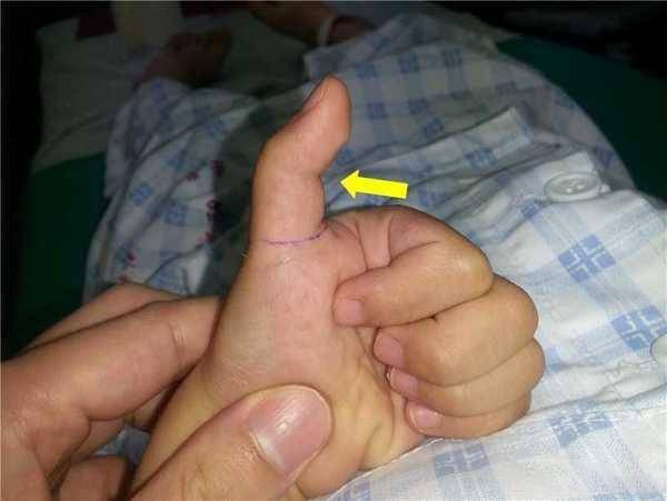 宝宝15个月大,最近发现俩手大拇指关节伸不直,该怎么办?