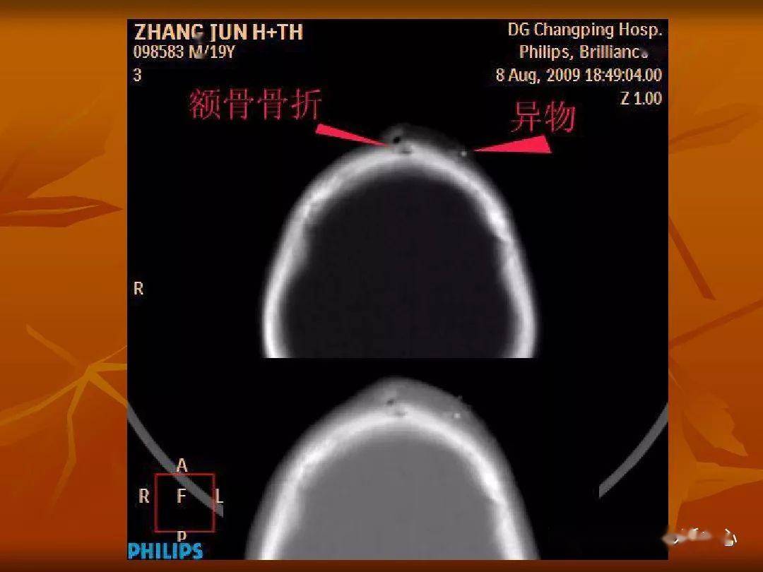 颅骨外伤性骨折ct诊断