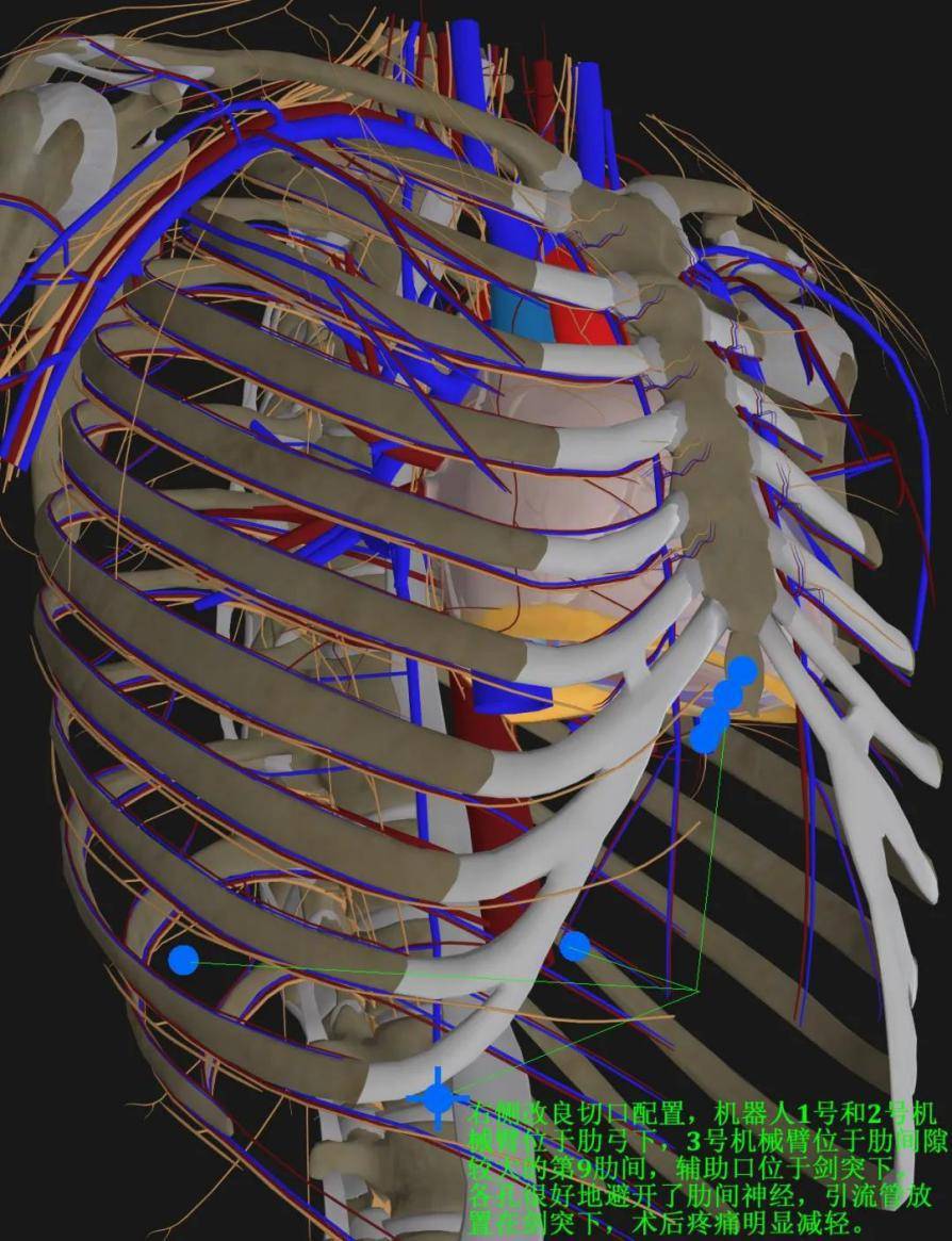 哈爾濱醫大四院機器人胸部微創手術 不再刺痛肋間神經