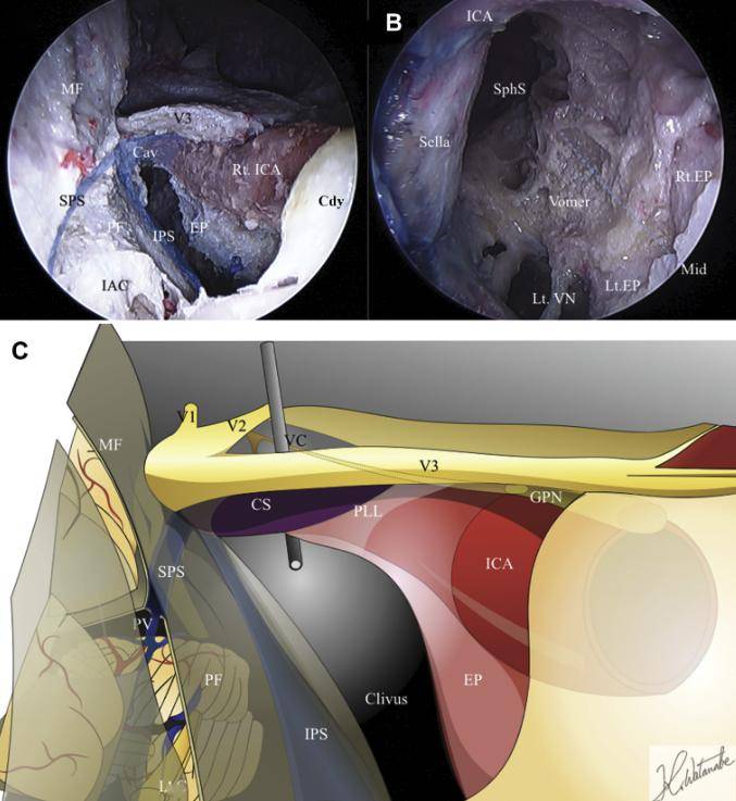 在內鏡和神經導航輔助下擴大經巖骨菱形區入路和經v2v3神經間隙處理