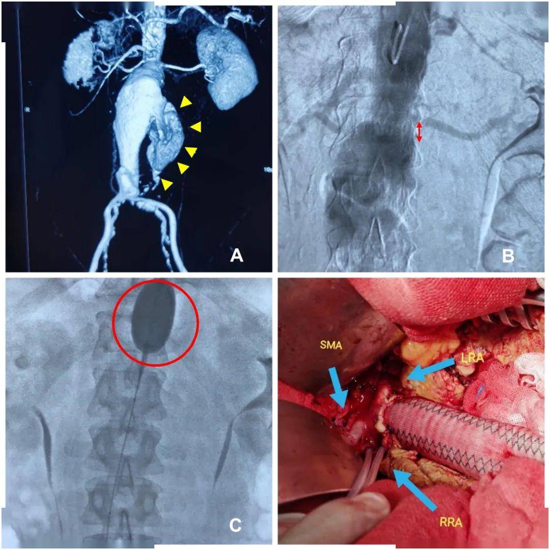 附属省立医院分别应用腔内技术和开放手术成功抢救两例腹主动脉瘤破裂