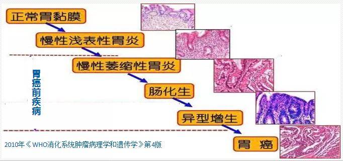 而正常胃黏膜发展到胃癌是一个漫长的逐渐演变的过程,即慢性浅表性
