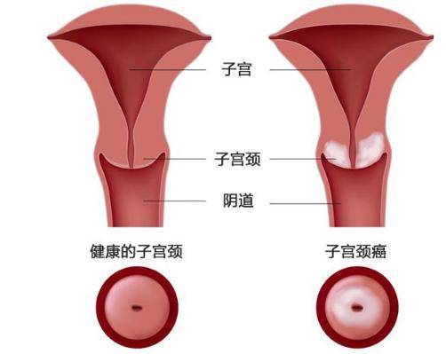 女性排卵期宫颈图片图片