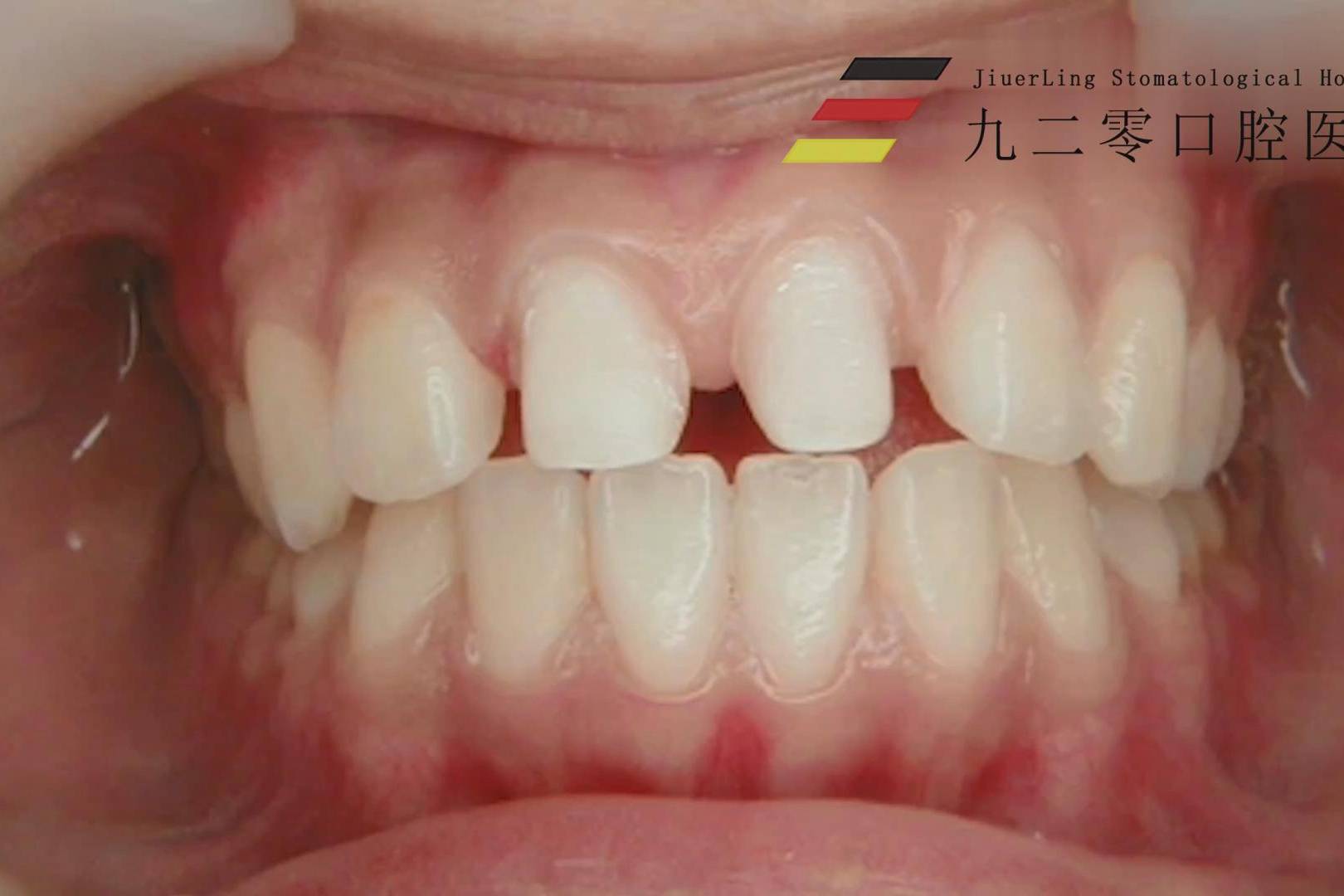 济南九二零口腔医院门牙间隙贴面治疗案例