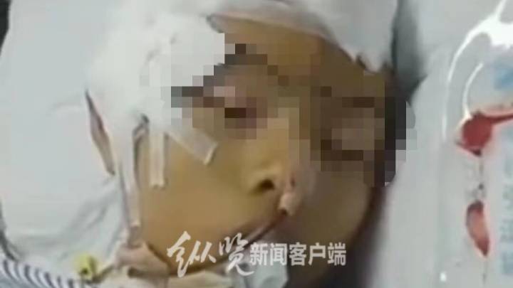 中学生疑被三名学生打成植物人，应该移交刑侦大队吗？