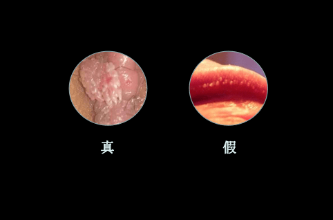 柚子肉条状假性疣图片图片