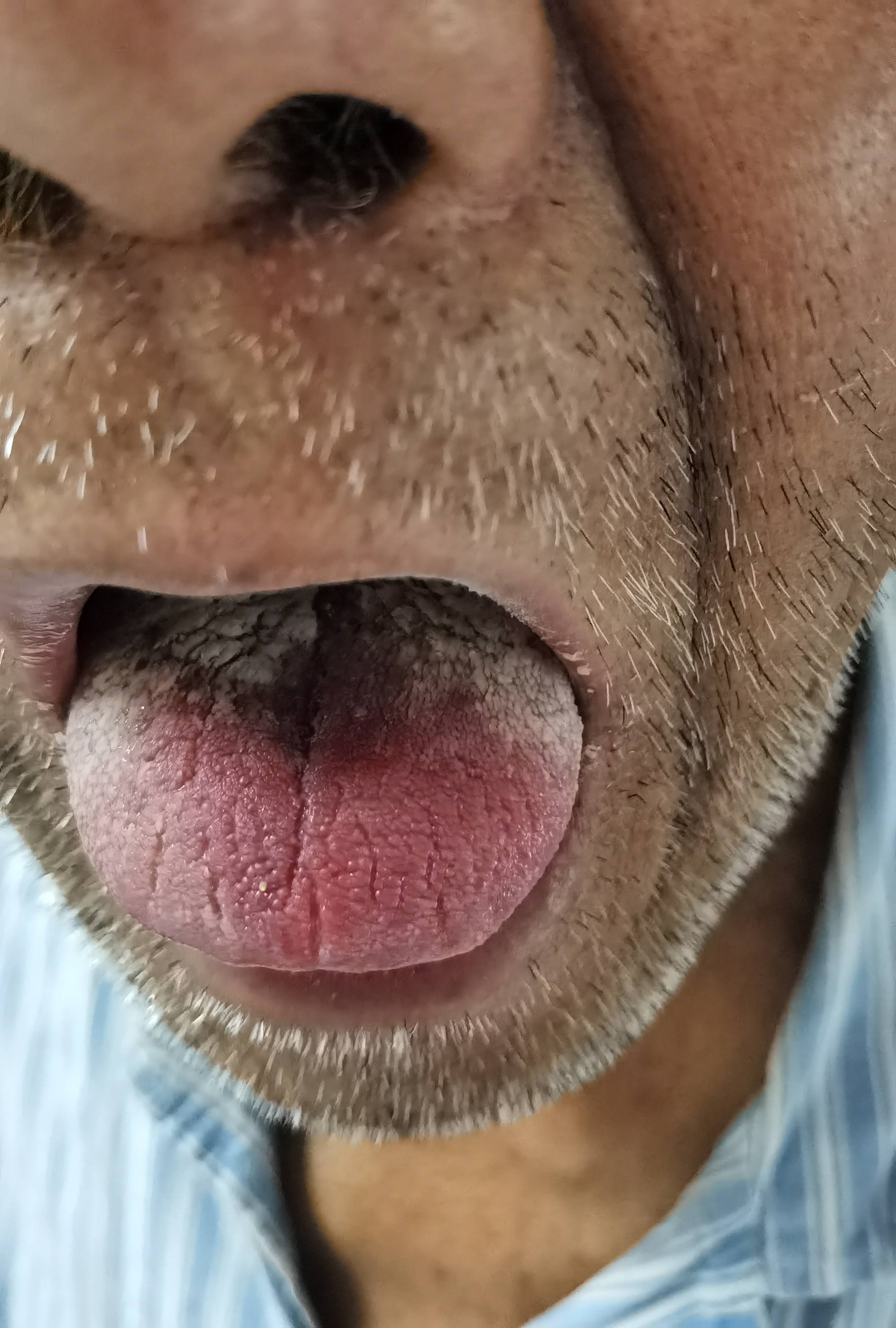 肺癌舌苔图片