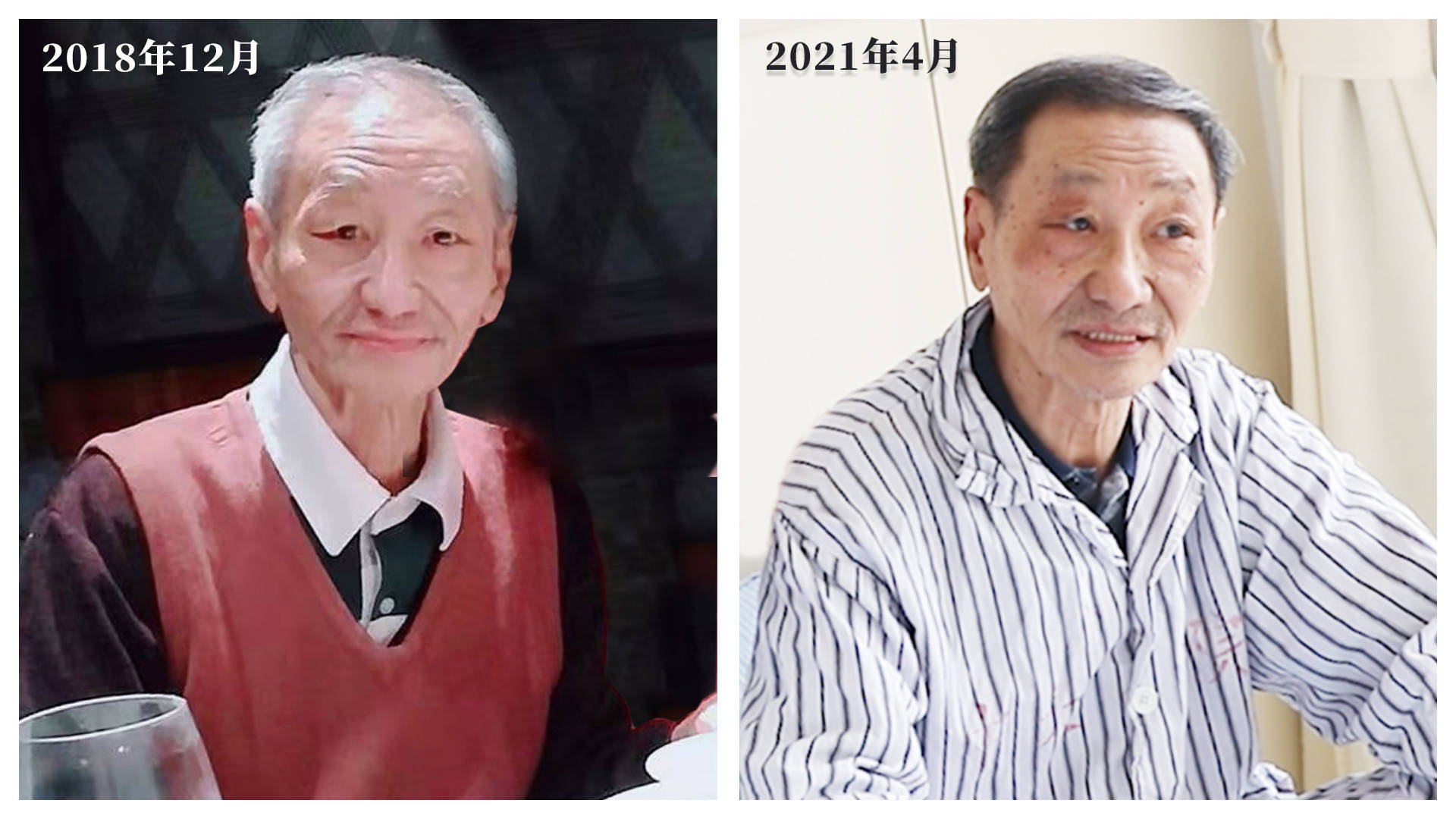 碘粒子治疗显生机,73岁癌症患者恢复神奇白发变黑发_老邵