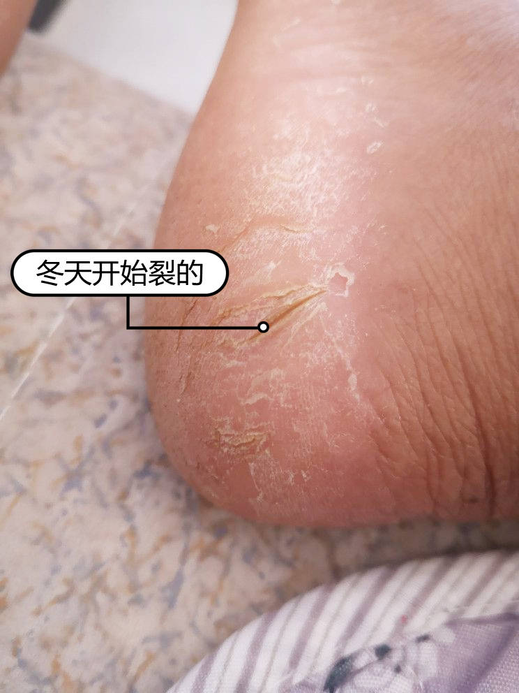 为什么脚裂一直不好医生劝诫做好3件事早知道早好
