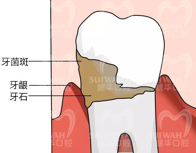 为什么牙结石会长在牙龈下面