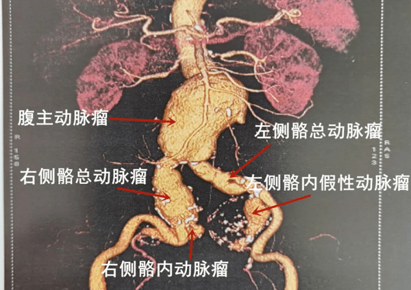 腹主动脉影像解剖图图片