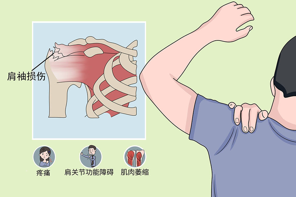 velpeau維力健肩袖損傷能自愈嗎需要多久治癒