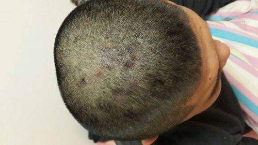 脂溢性皮炎治疗用药