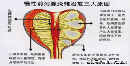 前列腺炎性分泌物图片图片