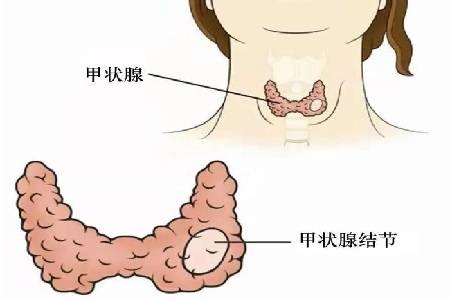 首大張洋:甲狀腺穿刺檢查有哪些注意事項