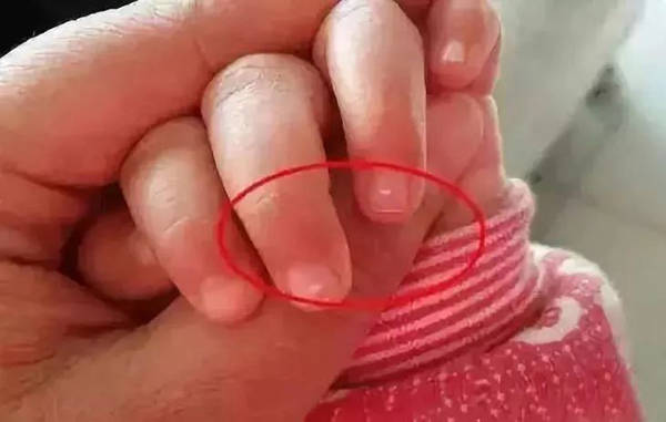 二,指甲的白色斑点是肠胃不适,贫血,营养不良导致的,也有可能是宝Ζ