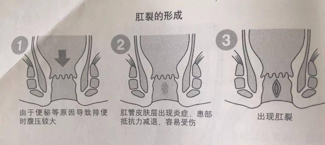 菊花残满地伤肛门疼就是肛裂了吗