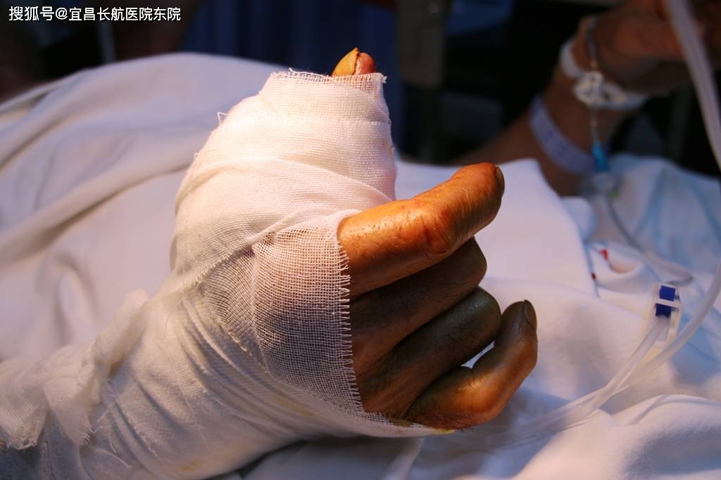 长航东院骨科手外伤找老张