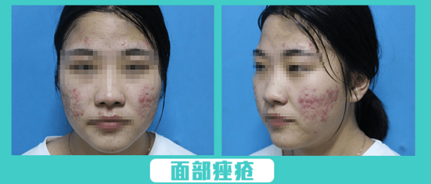 脸上长痘用什么洗面奶清痘 a01d8f6c7595401b8d696d25992e35f9.png