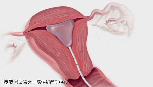 成功|【医问到底】什么是子宫内膜息肉？怎么进行处理？