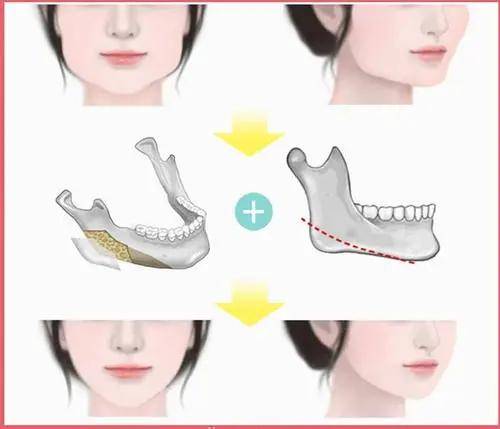 方法|圣嘉新邱立东：下颌角整形常识解答（一）