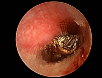 耳朵进了东西怎么办?_异物