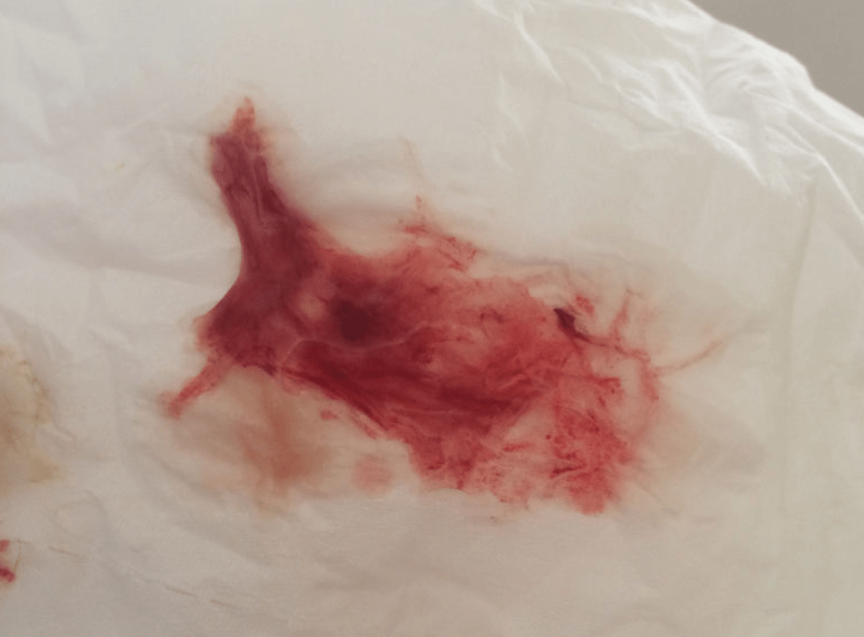 宫颈接触性出血图片