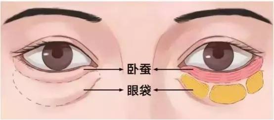 眼袋|眼袋和卧蚕到底有什么区别？别再傻傻分不清了！