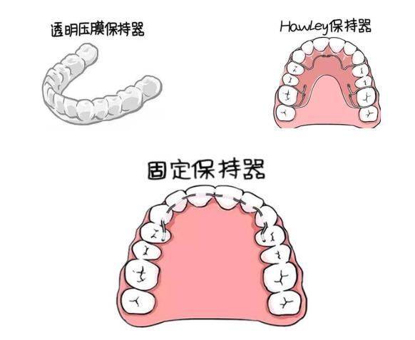 怎么正确佩戴保持器 8e632436cc514d6dbe3b926bad56f54f.jpeg