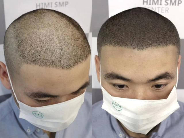毛囊|黑米3D纹发：拯救发际线危机火急火燎，植发好还是纹发好呢？