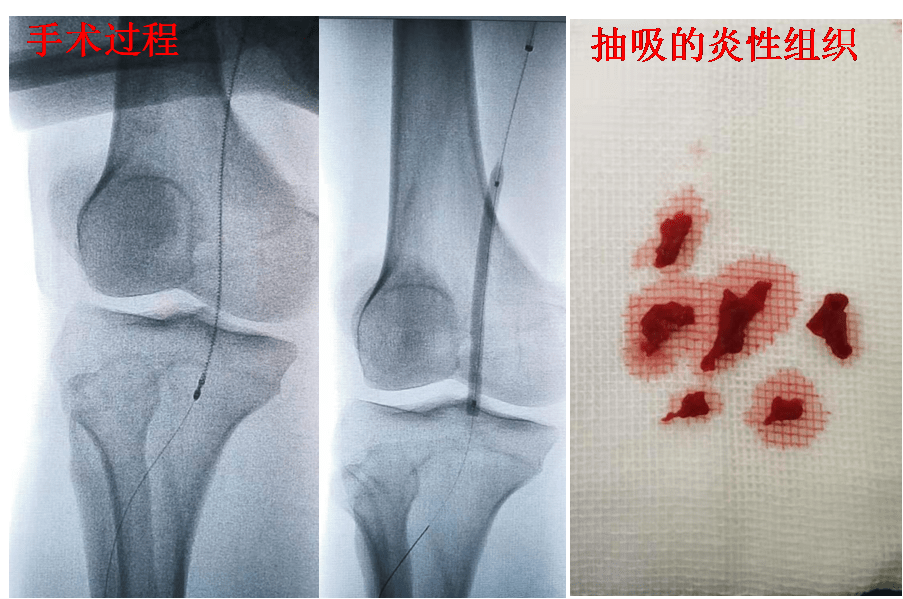 血栓|脉管炎微创治疗取得进展, 交大一附院血管外科再创西北首例