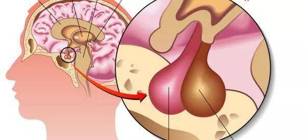 科普|【疾病科普】哪些垂体瘤患者适合手术？会出现哪些症状？