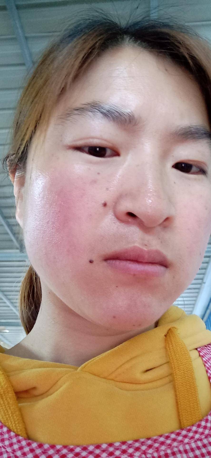 什么|je莫倩:激素脸流水怎么办?什么是激素脸?