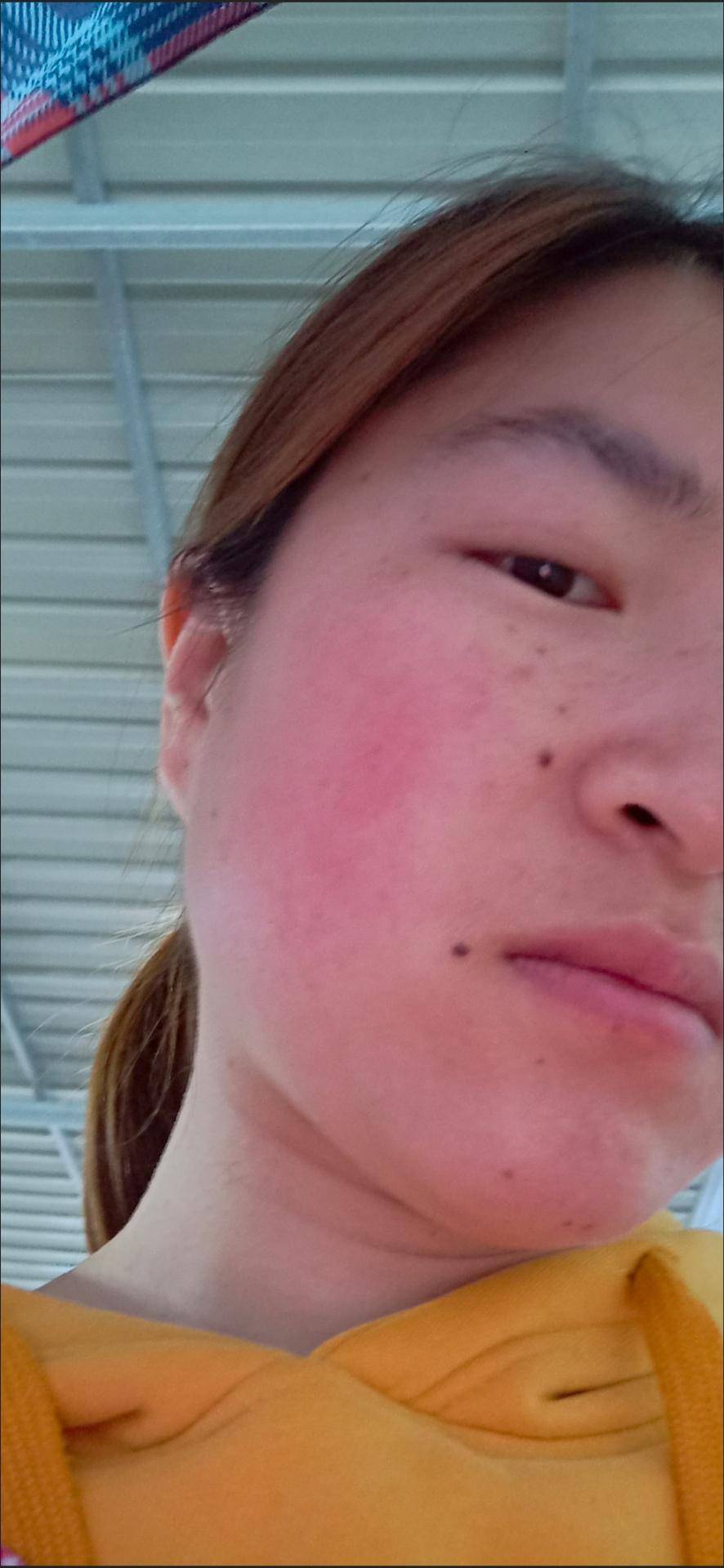 什么|je莫倩:激素脸流水怎么办?什么是激素脸?