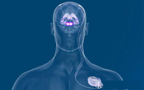 手术|适合DBS治疗的帕金森病患者应符合的条件