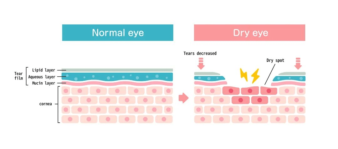 何而生|吴锦威老师：20多岁的我出现眼纹了，眼纹还能抚平吗？