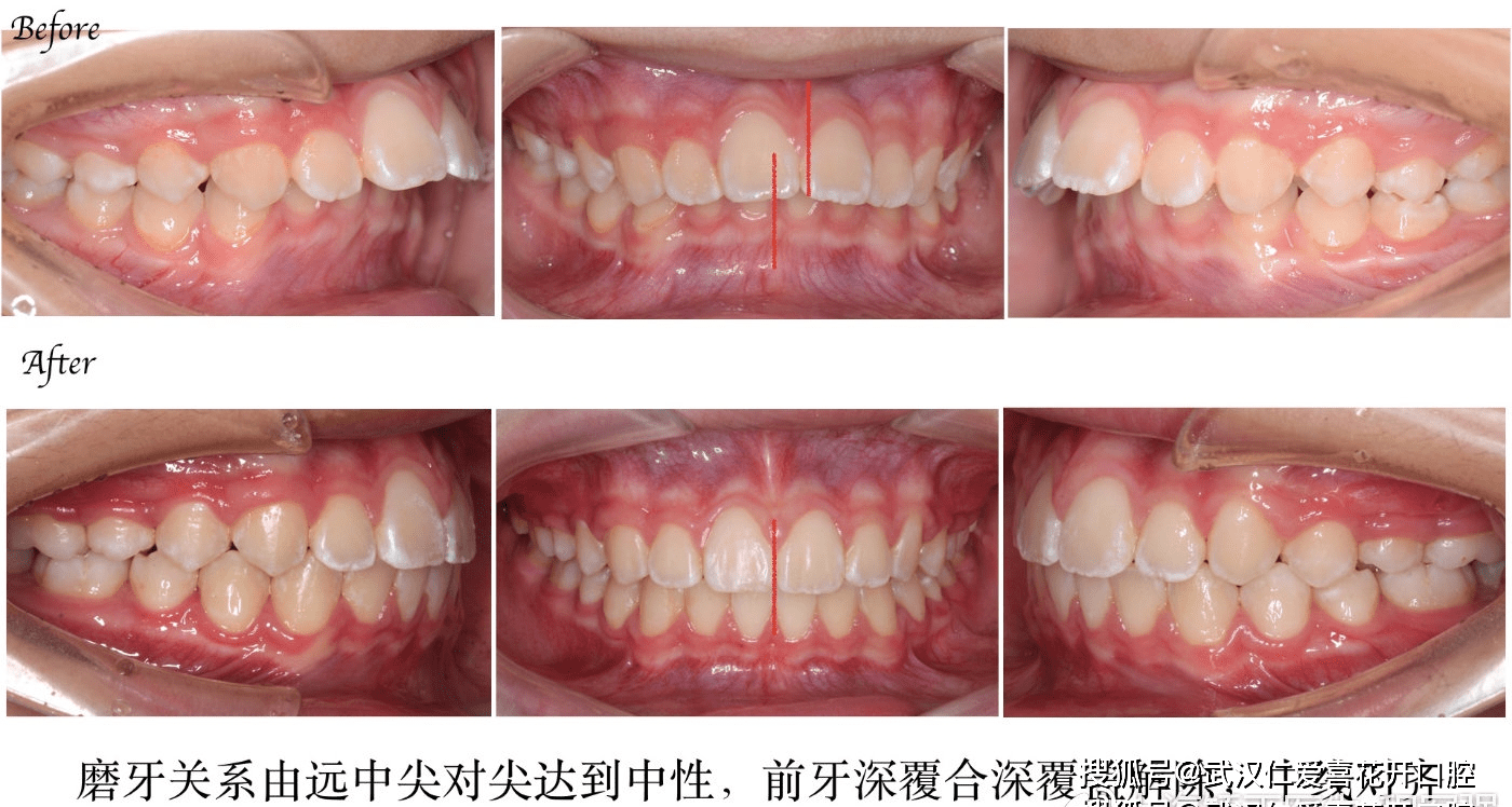 仁愛口腔嚴重突面畸形的矯形治療