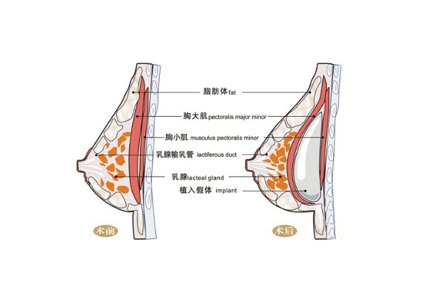 并发症|BTV《北京您早》专访圣嘉新才杰：隆胸要注意哪些风险