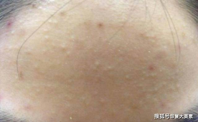 治疗|闭口粉刺会自动消失吗？不会！ 掌握这三点，痘痘问题不在惧