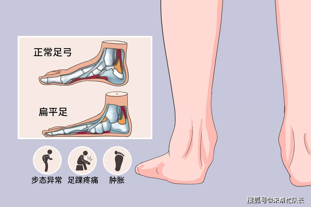 扁平足能平的有多夸张这些危害千万不能忽视