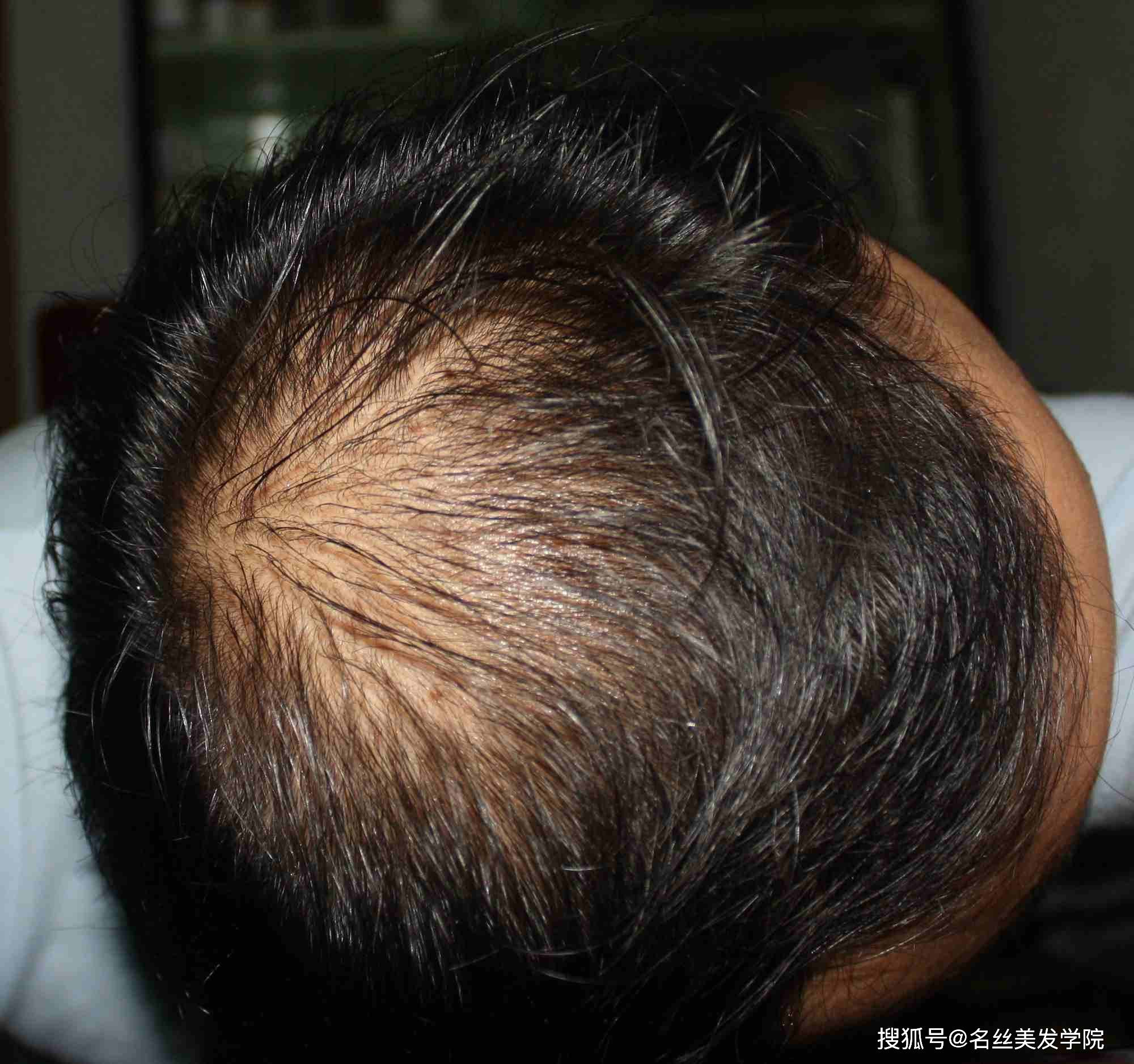 脱发严重是什么导致的原因 9219ff525f3b4d3e956b0994c6cc85da.jpeg